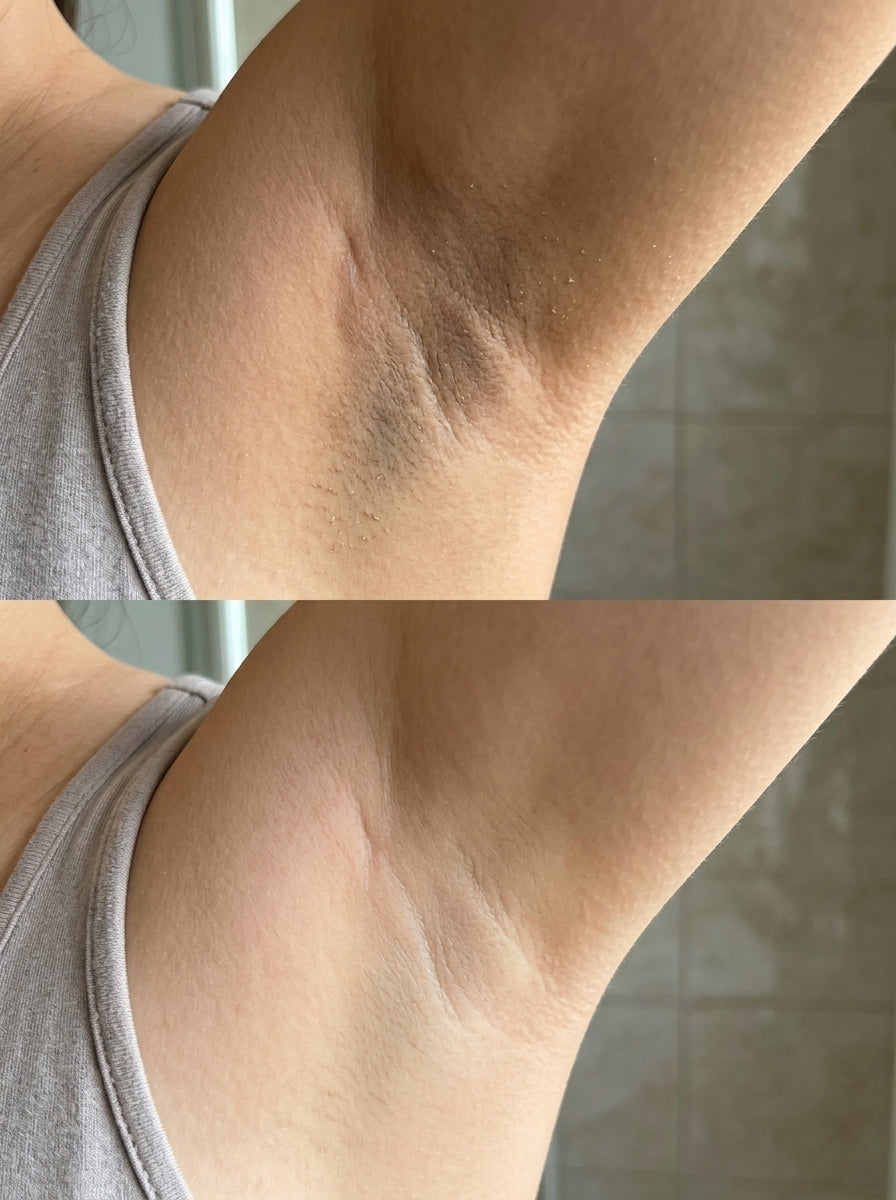 Antes e depois — Axilas escuras